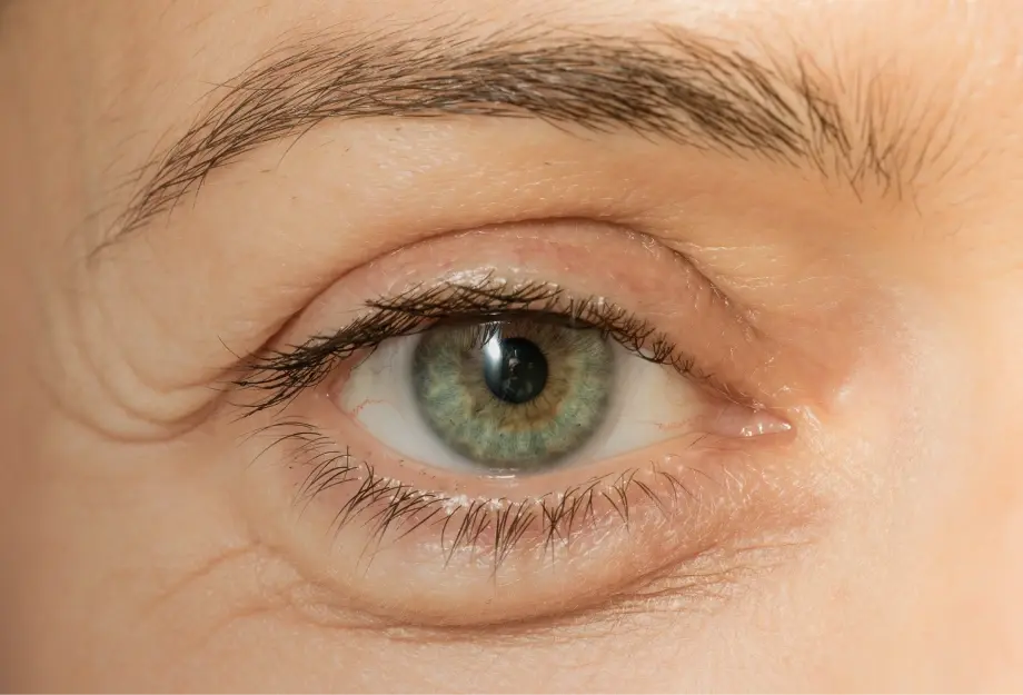 Am I a Suitable Candidate for Blepharoplasty?