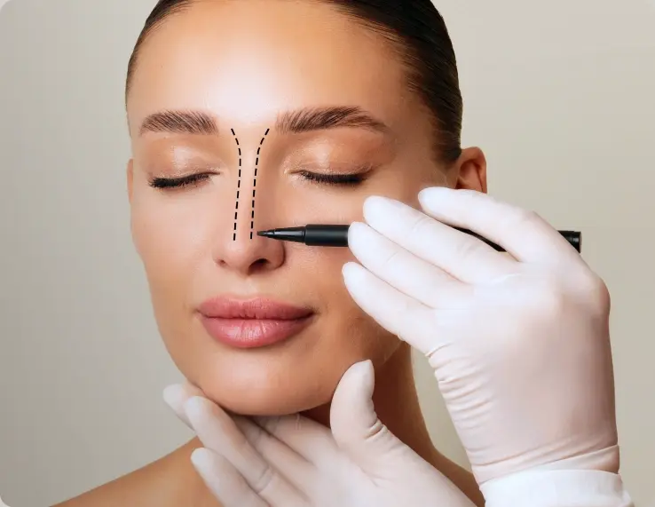 Rhinoplasty procedure